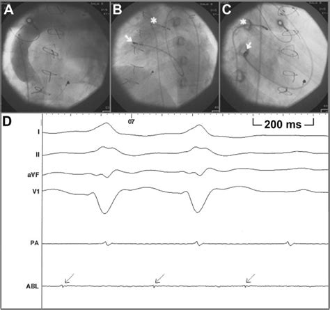 A Postero Anterior Projection Of Angiogram Of The Extracardiac Conduit