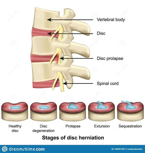 Stagesofdischerniationspineanddiscanatomy3dmedicalvector