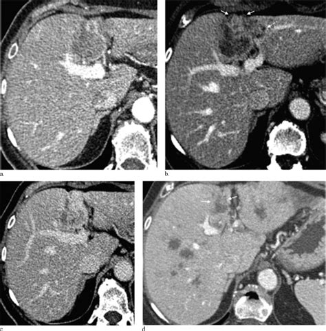 Updated Management Of Malignant Biliary Tract Tumors An Illustrative