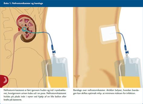 Bandagering Og Hudpleje Ved Nefrostomikatetre Dsr Dk