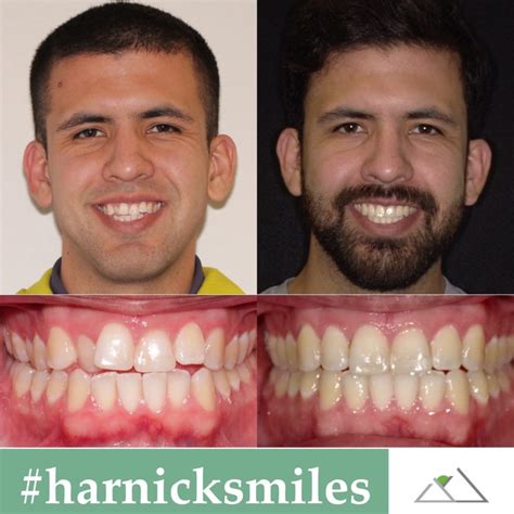 Harnick Orthodontics Albuquerque Braces And Invisalign Results