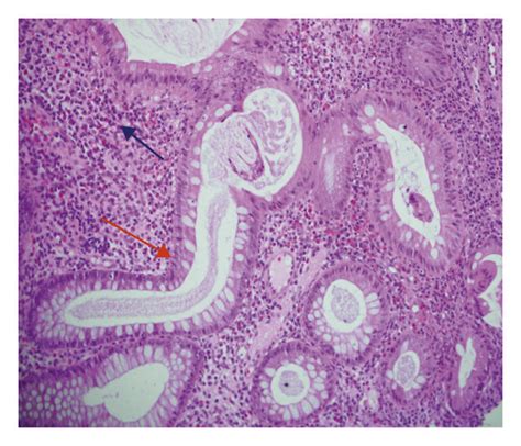 Histopathology Of Descending Colon Biopsy Showing Uc Picture