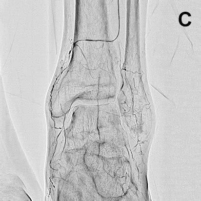 Trinias Minimally Invasive Experience