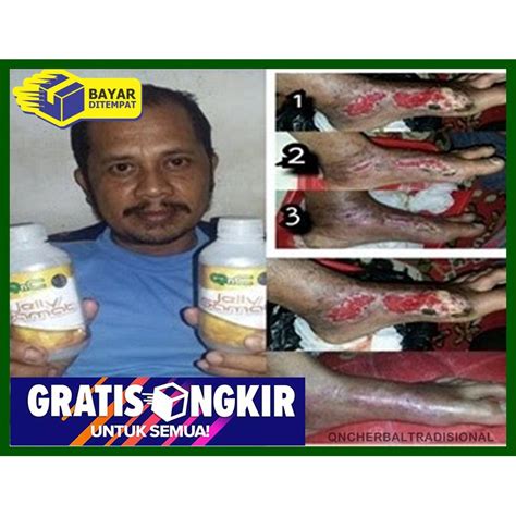 Jual Obat Luka Diabetes Di Kaki Pengering Luka Gangren Koreng