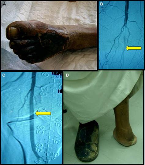 Outcome Of Midfoot Amputations In Diabetic Gangrene Annals Of