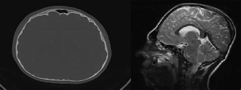 Synostosis Brachicephali And Diffuse Indentation Beaten Cooper