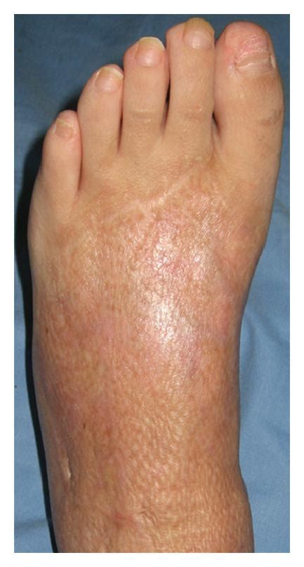 Thirty Four Year Old Female Mesh Skin Grafted Scars On Left Foot Deep