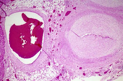 Diagnosis Treatment And Long Term Management Of Kawasaki Disease A