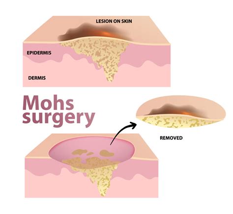 Mohs Micrographic Surgery Advanced Skin And Laser Center