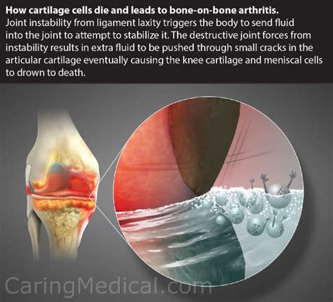 Treating Chronic Knee Swelling Knee Synovitis And Inflammation Without