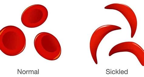 Eliminate Sickle Cell Anemia By 2047 In Hindi सिकल सेल एनीमिया 2047