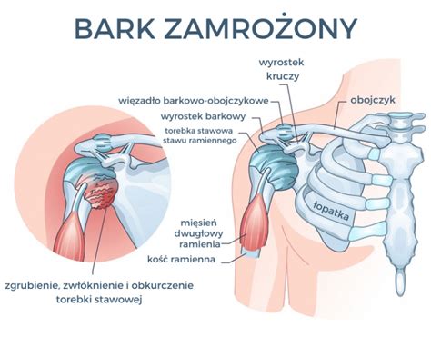 Bark Zamro Ony Po Czym Rozpozna To Schorzenie I Jak Je Wyleczy