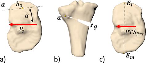 A Simple Formula To Control Posterior Tibial Slope During Proximal