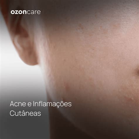 Ozoncare Acne E Inflamações Cutâneas Rotina De Cuidados Philozon