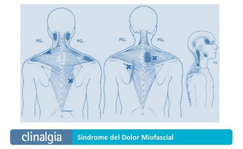 Síndrome Del Dolor Miofascial Qué Es Síntomas Y Tratamiento