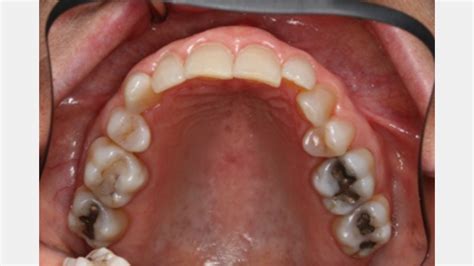 Maxillary First Premolar Extractions For Orthodontics A Red Flag For Joint Issues Spear