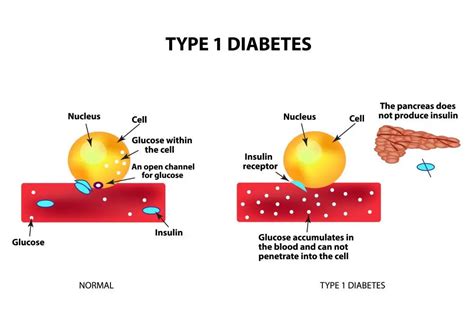 Pathophysiology Of Diabetes What Is It Reasons Infographics