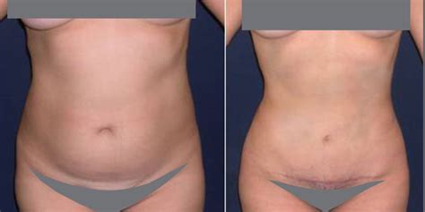 Abdominoplastia Cirug A Pl Stica La Serena