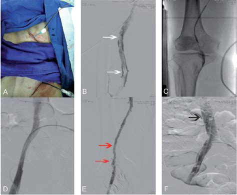 Percutaneous Mechanical Thrombectomy Combined With Catheter Directed