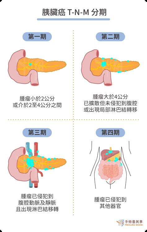 胰臟癌存活率高嗎？罹病原因、症狀、末期治療方式