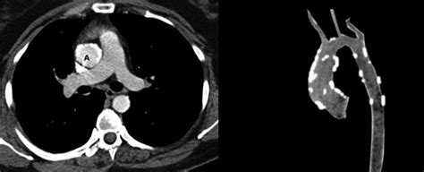 [figure Porcelain Aorta Image Courtesy S Bhimji Md] Statpearls