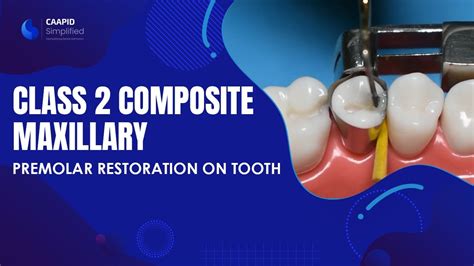 Class 2 Composite Maxillary Premolar Restoration On Tooth No 4 Full