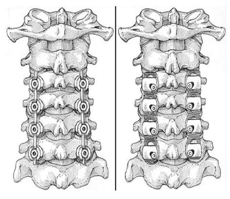 Lateral Mass Screws Fixation Of Cervical Spine