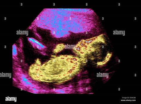 ULTRASOUND BIOMETRY OF THE FETUS Stock Photo Alamy