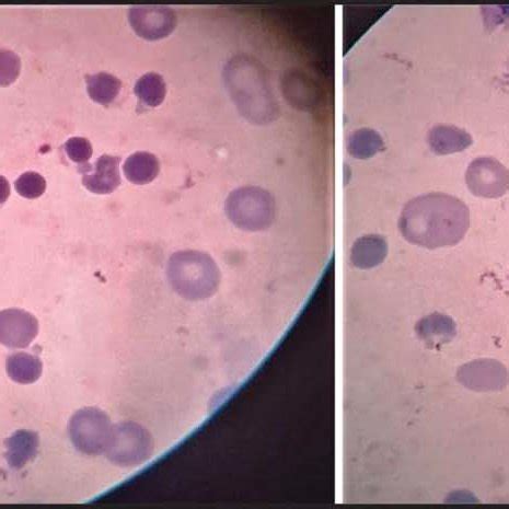 Figure: Microscopic picture of peripheral blood film showing ...