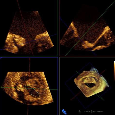 A three-dimensional (3D) echocardiogram showing planimetry of a ...