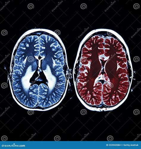 how to detect brain tumor at home 6