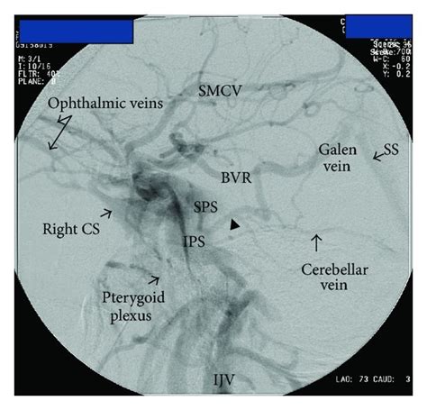 Lateral A And Anteroposterior B Dsa Views Of A Posttraumatic