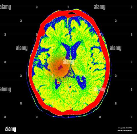 CT Brain Perfusion Or CT Scan Image Of The Brain Axial View Showing