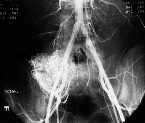 Pre Embolization Aorto Iliac Arteriogram Demonstrates A Hypervascular