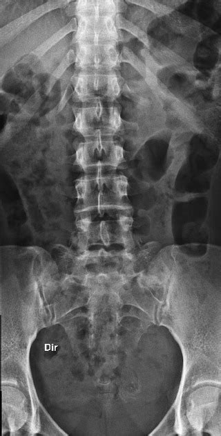 Lumbarized S1 Segment Pacs