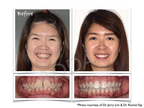 Smile Makeover Case Study 15 Porcelain Veneers Invisalign Before And