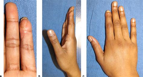 The Anterograde Homodigital Neurovascular Island Flap Journal Of Hand Surgery