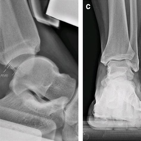 Tibial Fixation With Tightrope Rt A Left Knee Is Viewed From The Left