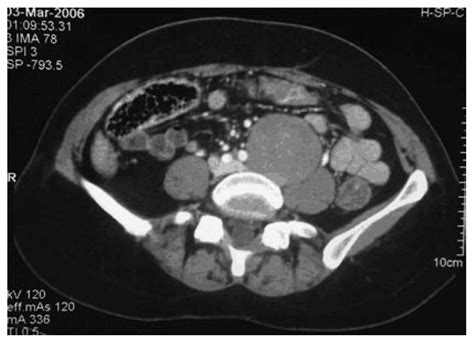 Benign Retroperitoneal Schwannoma Presenting As Colitis A Case Report