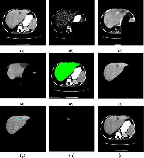 Liver Tumour Detection And Classification Using Partial Differential Technique Algorithm With