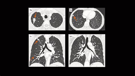 Metastatic Pulmonary Adenocarcinoma Complicated By Pe Siemens Healthineers