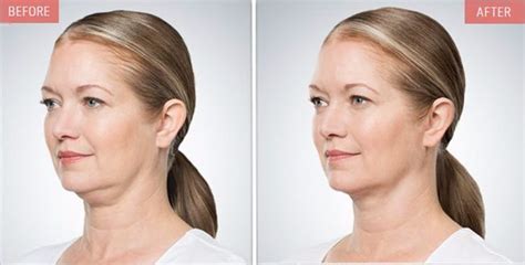 Kybella Double Chin Reduction Injection Pasadena Glendale Burbank