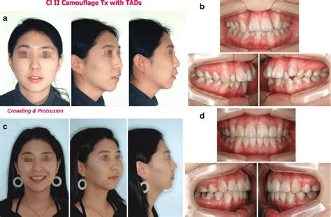 Class Ii Malocclusion Treatment Malcom Hitt