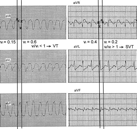 New Algorithm Using Only Lead AVR For Differential Diagnosis Of Wide