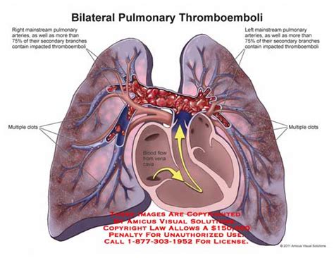 Amicus Illustration Of Amicus Injury Lungs Bilateral Pulmonary