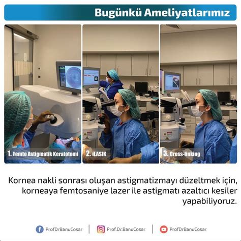 Kornea nakli sonrası oluşan astigmatizmayı düzeltmek için korneaya