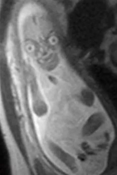 Cursed Image Of Unborn Baby Taken During Mri Scan Left Reddit Users