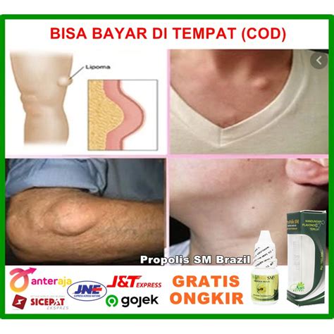 Jual Obat Uci Uci Benjolan Lipoma Benjolan Di Leher Kelenjar Getah