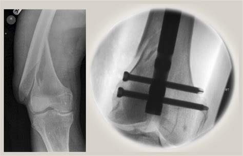 Intramedullary Nailing Of Femoral Shaft Fractures In Adults