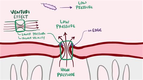 Endocarditis Infective Libman Sacks Causes Symptoms Treatment